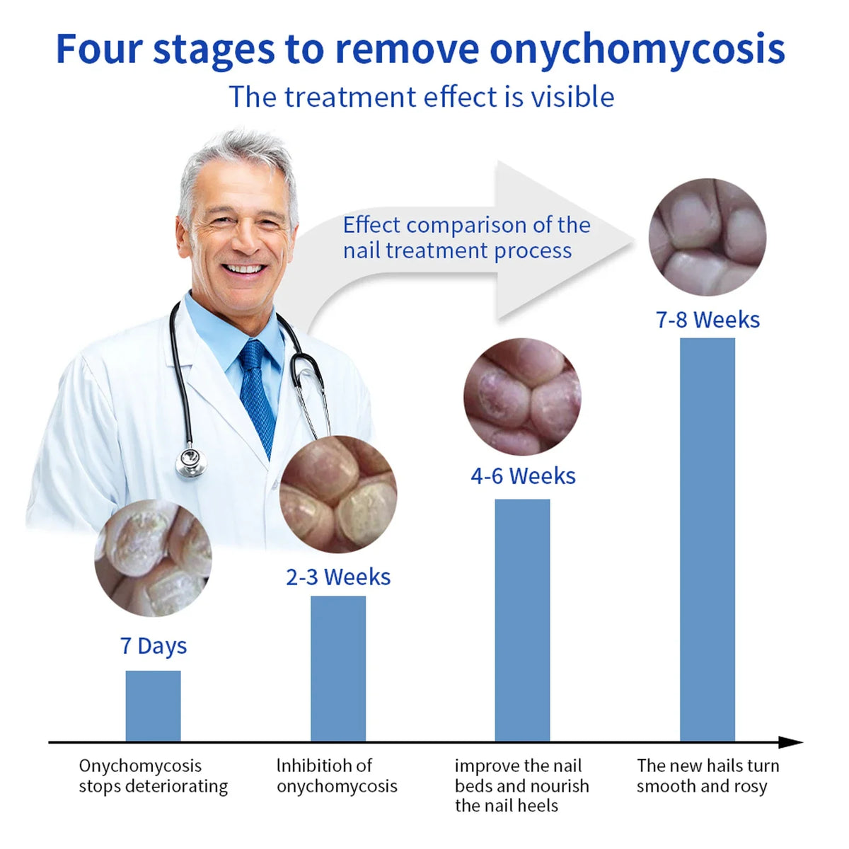 Infographic showing four stages to remove onychomycosis, demonstrating the visible treatment effect over 7-8 weeks.