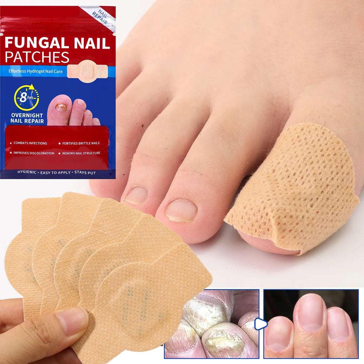 Disposable fungal nail patches applied to a foot, showing the product packaging and usage.