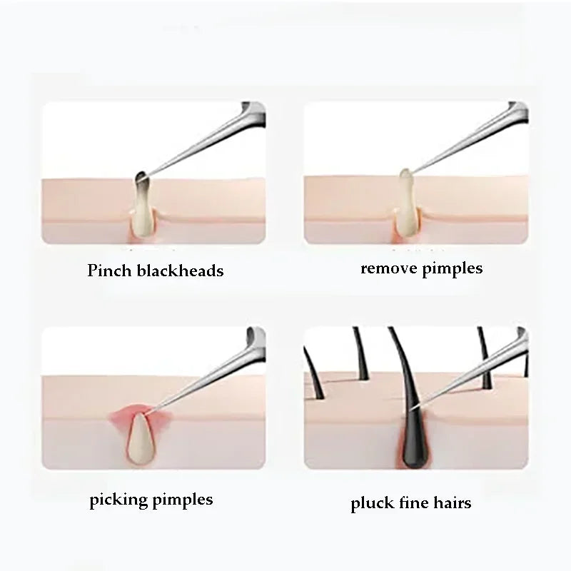 A set of stainless steel tools for skin care including pinch blackheads, removing pimples, picking pimples, and plucking fine